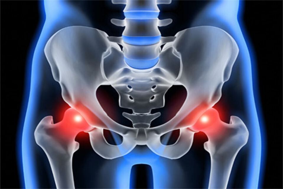 Artrosi deformante delle articolazioni dell'anca (coxartrosi)