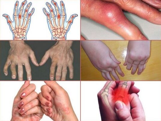 Dolore alle articolazioni delle dita
