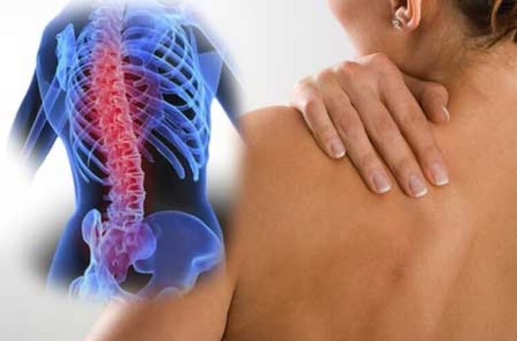 Con un'esacerbazione dell'osteocondrosi della colonna vertebrale toracica, si verifica dolore dorsago