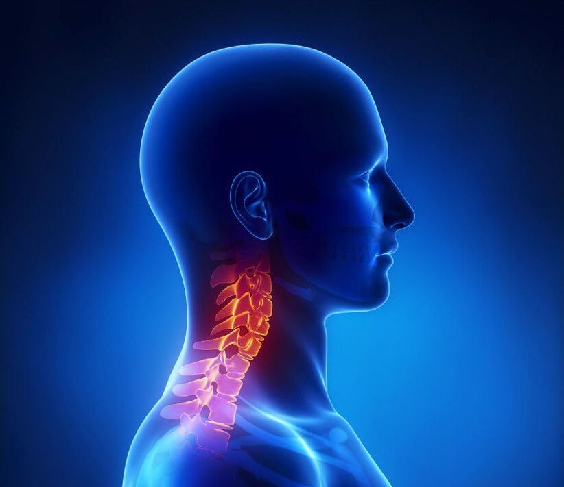 L'osteocondrosi cervicale è una patologia della colonna vertebrale di cui puoi liberarti a casa