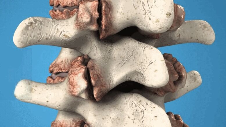 Osteofiti della colonna vertebrale come causa di mal di schiena