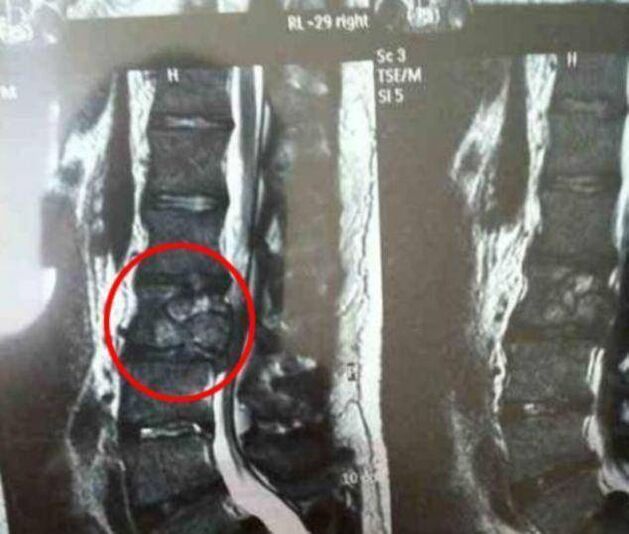 Tumore spinale come causa di mal di schiena