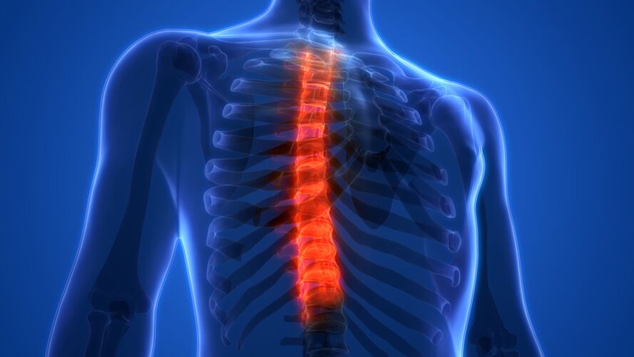 Osteocondrosi della colonna vertebrale toracica, caratterizzata dalla distruzione dei dischi intervertebrali