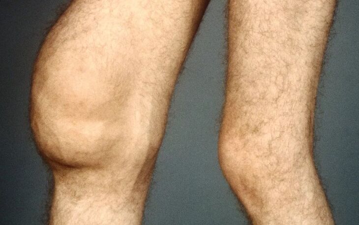 Osteoartrite post -traumatica dell'articolazione del ginocchio