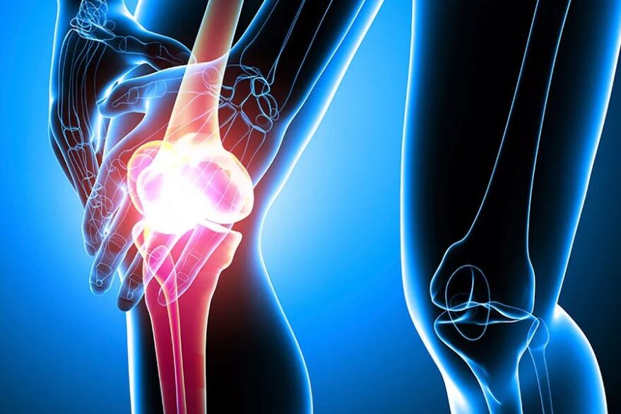 Osteoartrosi del ginocchio