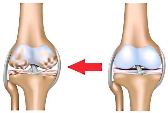 Articolazioni sane e osteoartrite