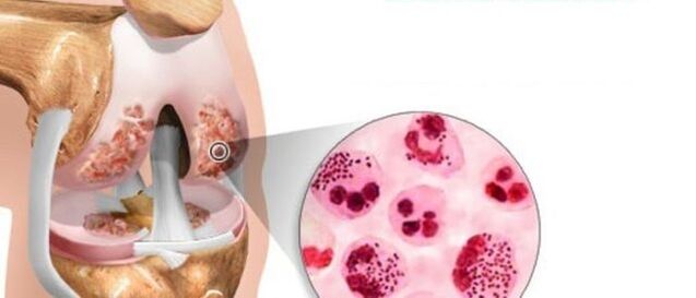 Questo porta allo sviluppo dell'osteoartrite
