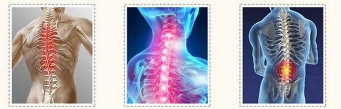 Lesioni della colonna vertebrale dell'osteocondrosi