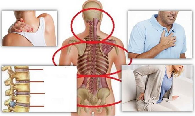 Posizioni di malattia per osteocondosi
