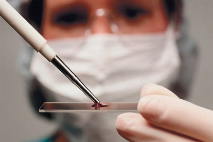 L'artrite è una malattia infiammatoria la cui presenza viene determinata attraverso esami del sangue.