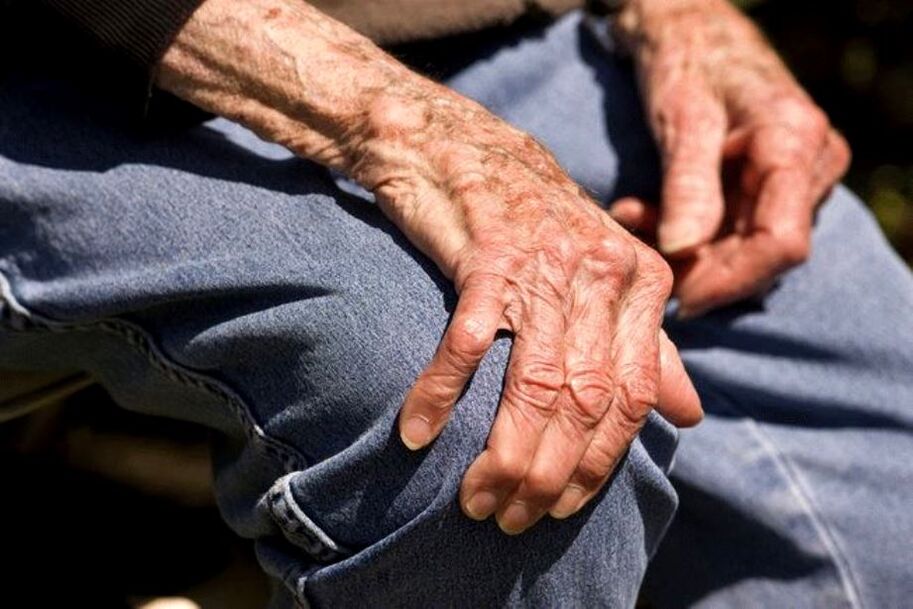L’artrosi è una malattia legata all’età che colpisce le persone anziane