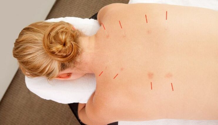 Agopuntura per l'osteocondrosi toracica, che ha molti benefici