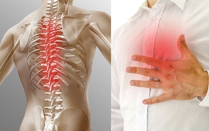 L'osteocondrosi toracica si manifesta come dolore e sensazione di oppressione al petto